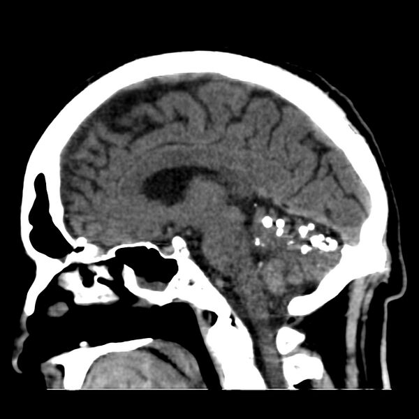 File:Brain Pantopaque remnants (Radiopaedia 78403-91048 C 31).jpg