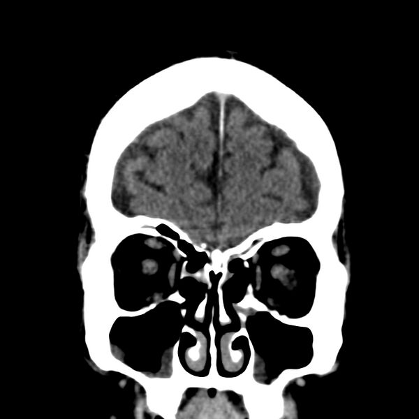 File:Brain Pantopaque remnants (Radiopaedia 78403-91048 Coronal non-contrast 14).jpg