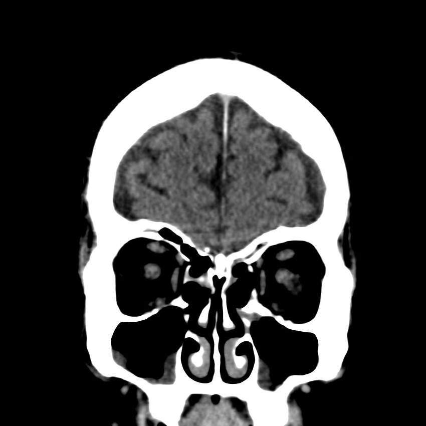 Brain Pantopaque remnants (Radiopaedia 78403-91048 Coronal non-contrast 14).jpg