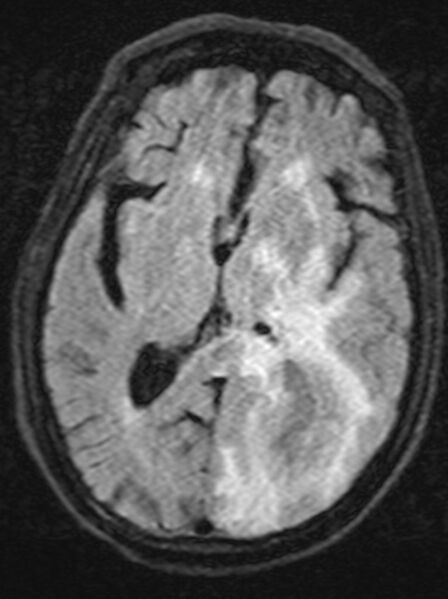 File:Brain abscess with dual rim sign (Radiopaedia 87566-103938 Axial FLAIR 12).jpg