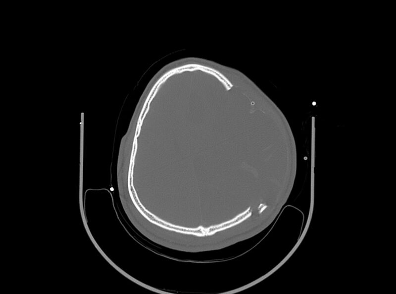 File:Brain injury by firearm projectile (Radiopaedia 82068-96087 A 133).jpg