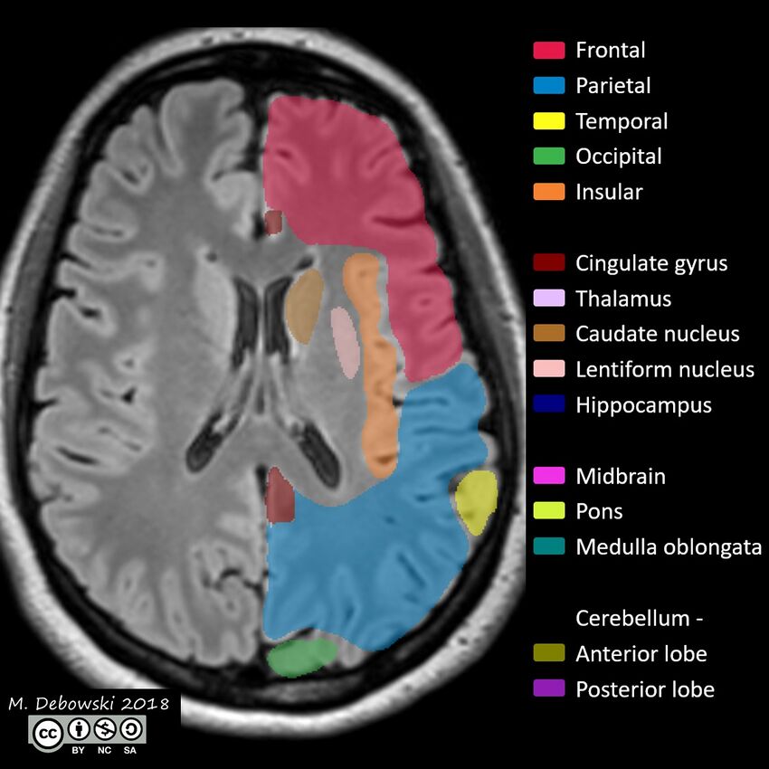 Brain lobes - annotated MRI (Radiopaedia 61691-69700 Axial 30).JPG