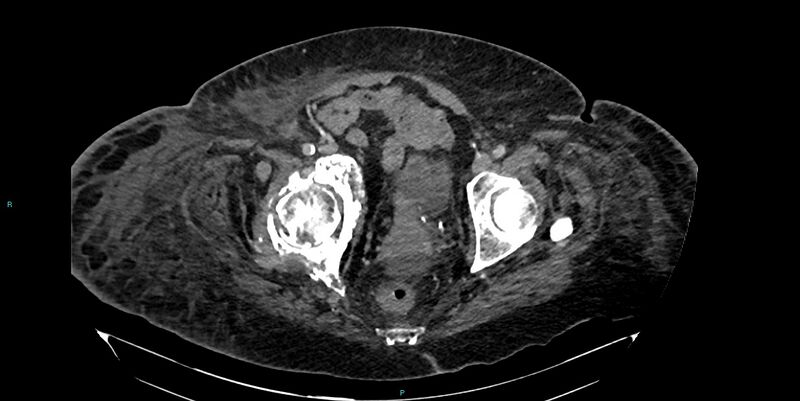 File:Breast cancer pelvic bony metastases (Radiopaedia 84470-99824 Axial bone window 54).jpg