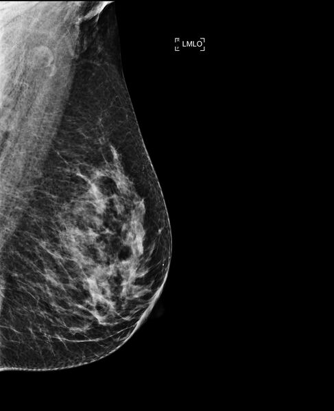 File:Breast hamartoma (Radiopaedia 63719-72417 B 1).jpg