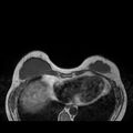 Breast implants - MRI (Radiopaedia 26864-27035 Axial T1 13).jpg