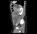 Broad ligament hernia (Radiopaedia 63260-71832 C 38).jpg