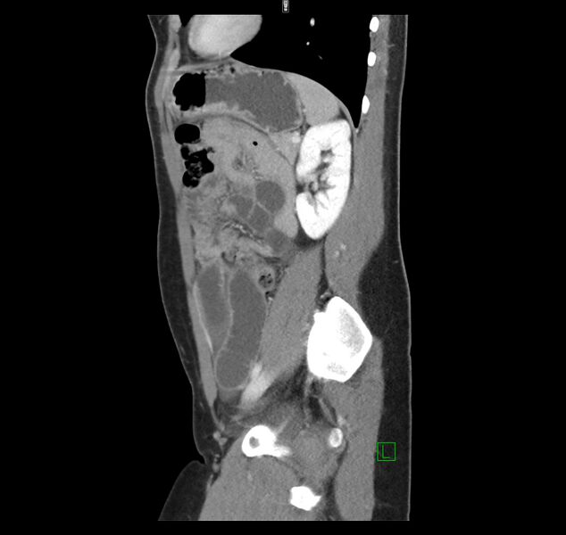 File:Broad ligament hernia (Radiopaedia 63260-71832 C 38).jpg