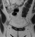 Broad ligament leiomyoma (Radiopaedia 81634-95516 Coronal T2 2).jpg