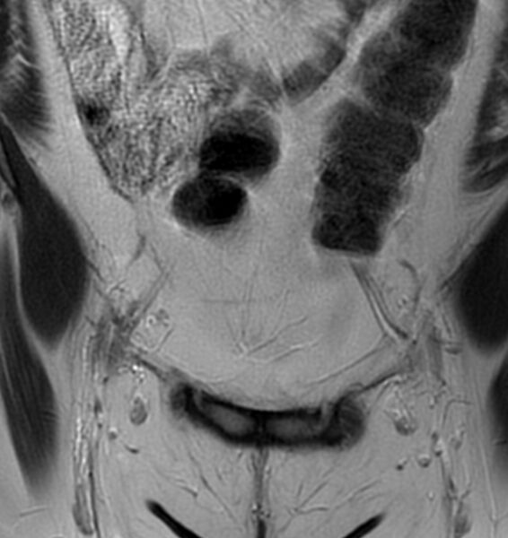 File:Broad ligament leiomyoma (Radiopaedia 81634-95516 Coronal T2 2).jpg