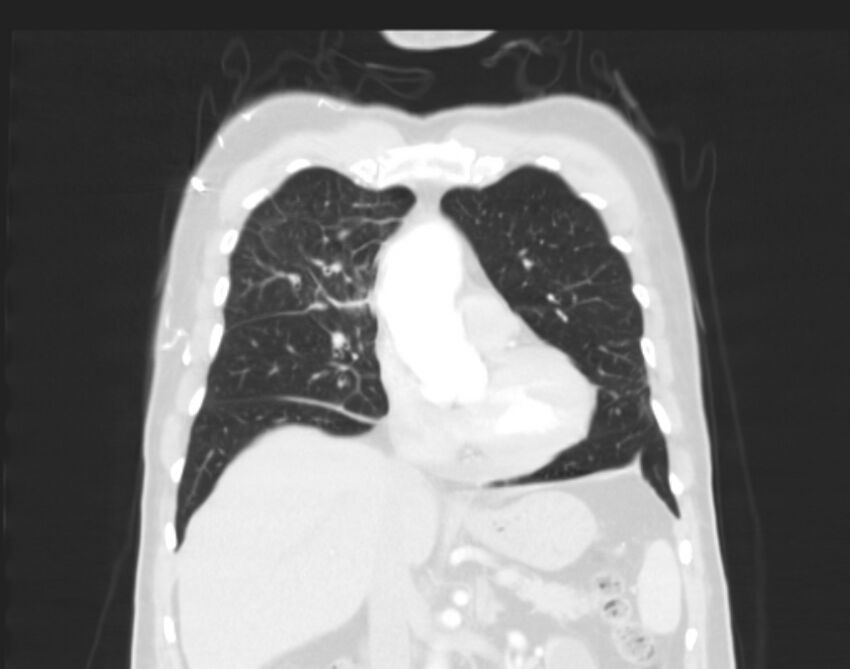 Bronchogenic carcinoma with lymphangitic spread (Radiopaedia 29002-29357 Coronal lung window 22).jpg