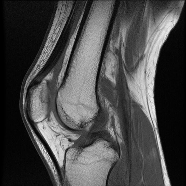 File:Bucket-handle meniscus tear (Radiopaedia 65700-74809 Sagittal T1 13).jpg