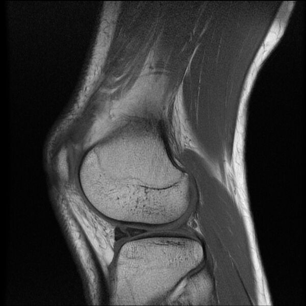 File:Bucket-handle meniscus tear (Radiopaedia 65700-74809 Sagittal T1 17).jpg