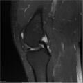 Bucket handle tear - lateral meniscus (Radiopaedia 7246-8187 Sagittal T2 fat sat 16).jpg