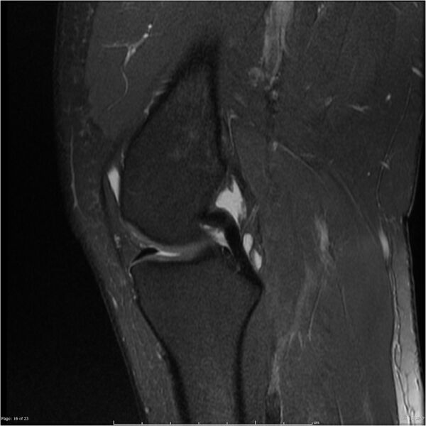 File:Bucket handle tear - lateral meniscus (Radiopaedia 7246-8187 Sagittal T2 fat sat 16).jpg