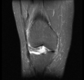 Bucket handle tear - medial meniscus (Radiopaedia 24900-25163 Coronal T2 fat sat 7).png