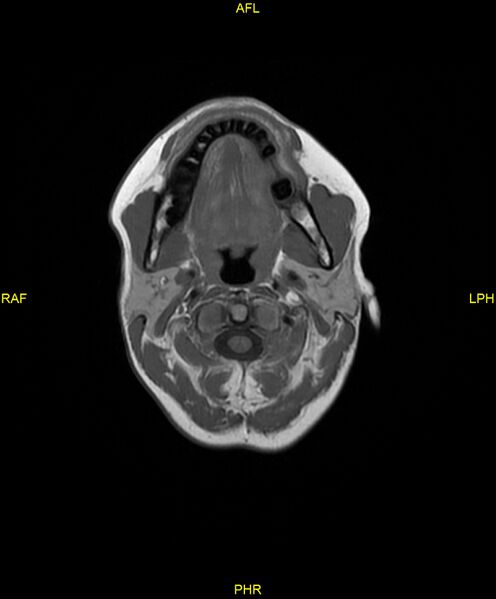 File:C5 nerve sheath tumor (Radiopaedia 85777-101596 Axial T1 4).jpg