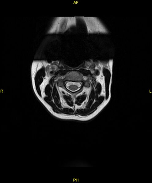 File:C5 nerve sheath tumor (Radiopaedia 85777-101596 Axial T2 1).jpg