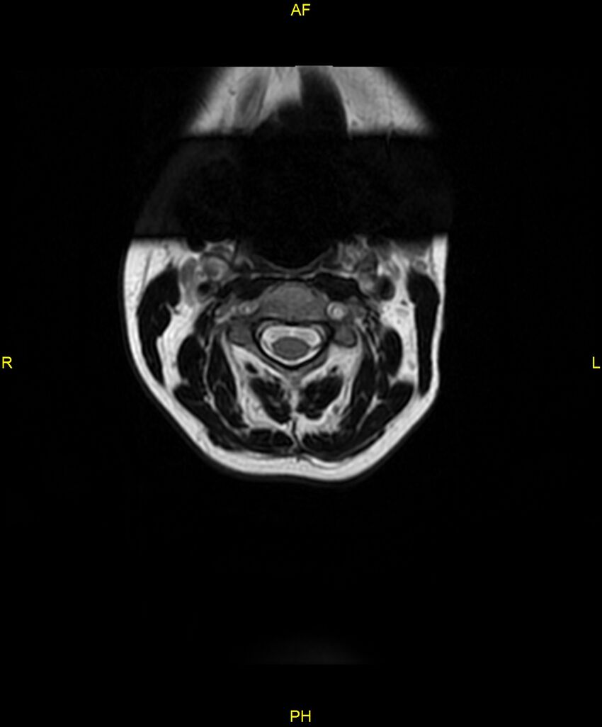 C5 nerve sheath tumor (Radiopaedia 85777-101596 Axial T2 1).jpg