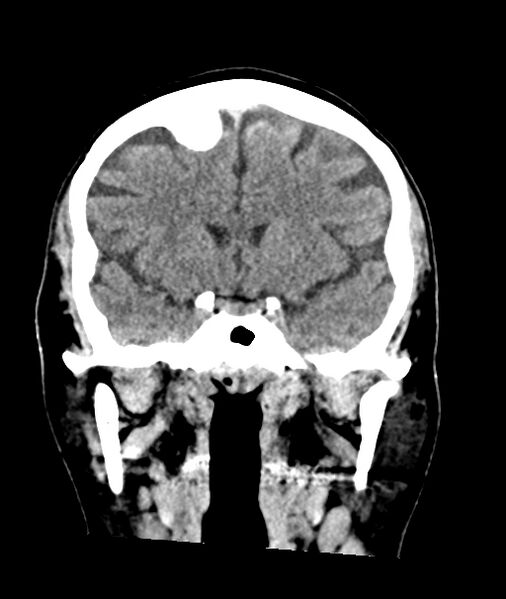 File:Calcified meningioma (Radiopaedia 74361-85243 Coronal non-contrast 20).jpg