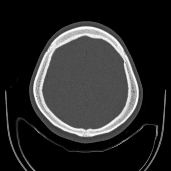 File:Calvarial osteoma (Radiopaedia 36520-38079 Axial bone window 86).jpg