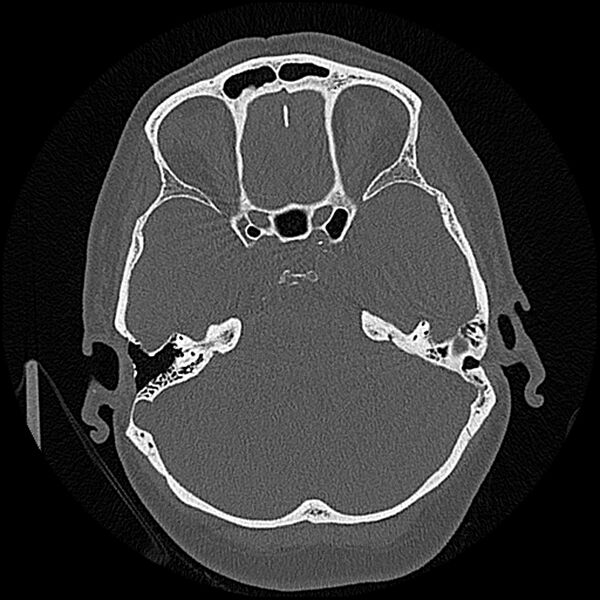 File:Canal up mastoidectomy (Radiopaedia 78108-90638 Axial bone window 100).jpg