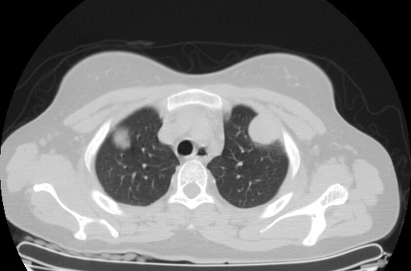 File:Cannonball metastases - uterine choriocarcinoma (Radiopaedia 70137-80173 Axial lung window 8).jpg