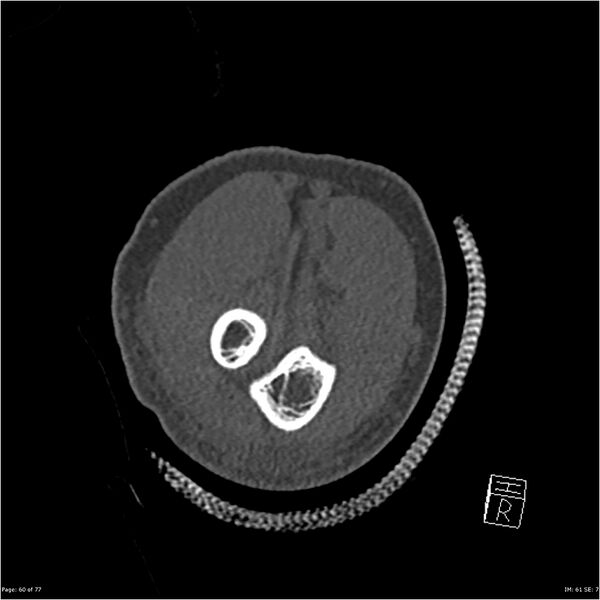 File:Capitellum fracture (Radiopaedia 23352-23426 Coronal bone window 60).jpg