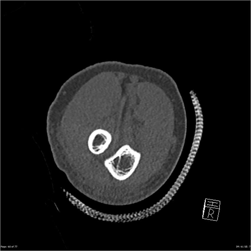 Capitellum fracture (Radiopaedia 23352-23426 Coronal bone window 60).jpg