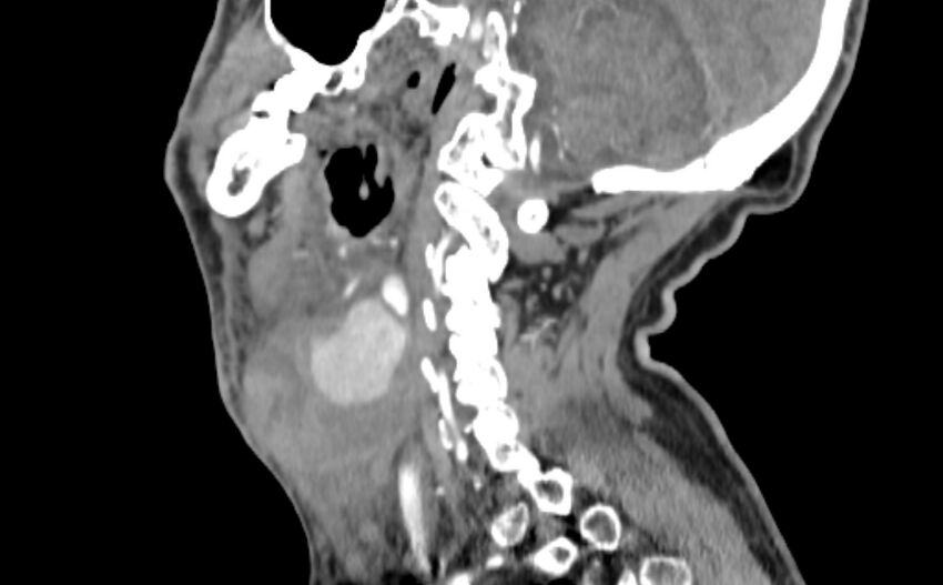 Carotid artery pseudoaneurysm (Radiopaedia 84030-99259 E 22).jpg