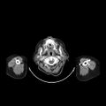 Carotid body tumor (Radiopaedia 21021-20948 B 7).jpg