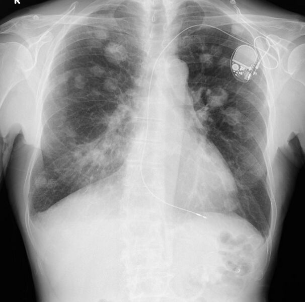 File:Cavitating lung metastases (Radiopaedia 76827).JPG