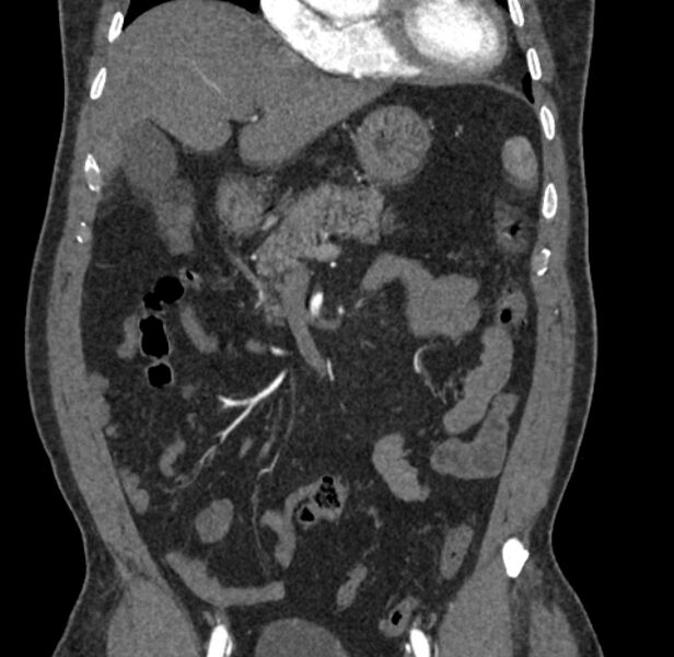 File:Celiac artery dissection (Radiopaedia 52194-58080 C 16).jpg