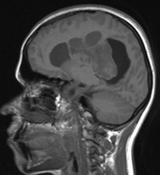 File:Central neurocytoma (Radiopaedia 9497-10178 Sagittal T1 1).jpg