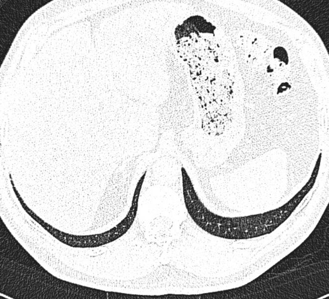 File:Centrilobular pulmonary emphysema (Radiopaedia 26808-26971 Axial lung window 37).jpg