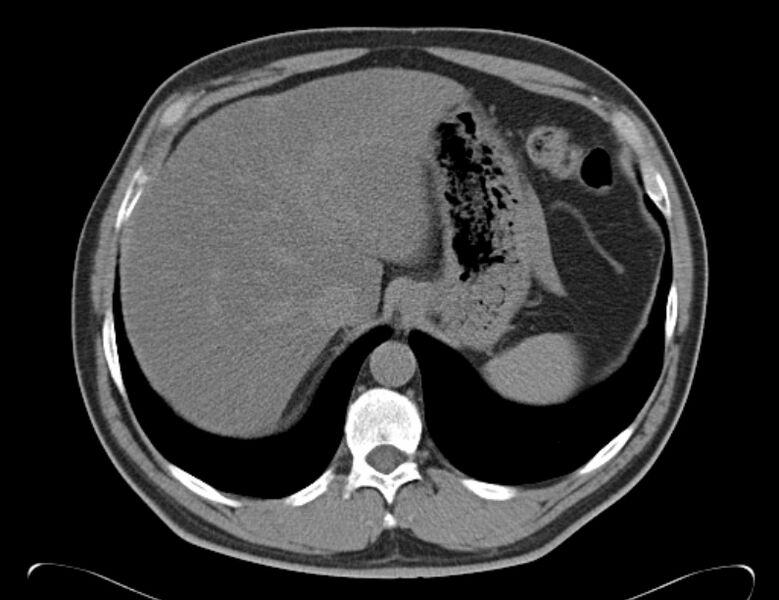 File:Centrilobular pulmonary emphysema (Radiopaedia 26808-26971 Axial non-contrast 40).jpg