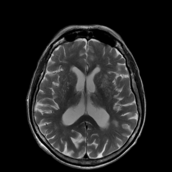 File:Cerebellar ataxia with neuropathy and vestibular areflexia syndrome (CANVAS) (Radiopaedia 74283-85159 Axial T2 13).jpg