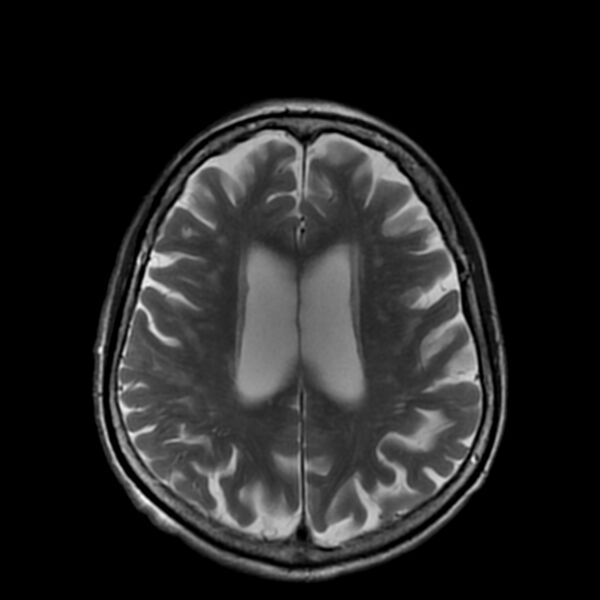 File:Cerebellar ataxia with neuropathy and vestibular areflexia syndrome (CANVAS) (Radiopaedia 74283-85159 Axial T2 15).jpg
