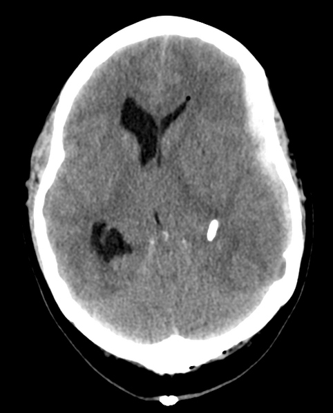 File:Cerebellar ependymoma complicated by post-operative subdural hematoma (Radiopaedia 83322-97737 Axial non-contrast 17).png