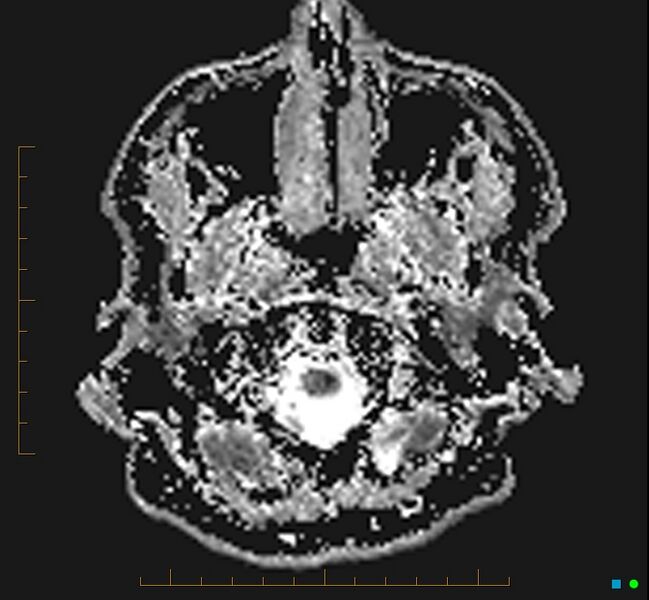 File:Cerebellar gangliocytoma (Radiopaedia 65377-74422 Axial ADC 2).jpg