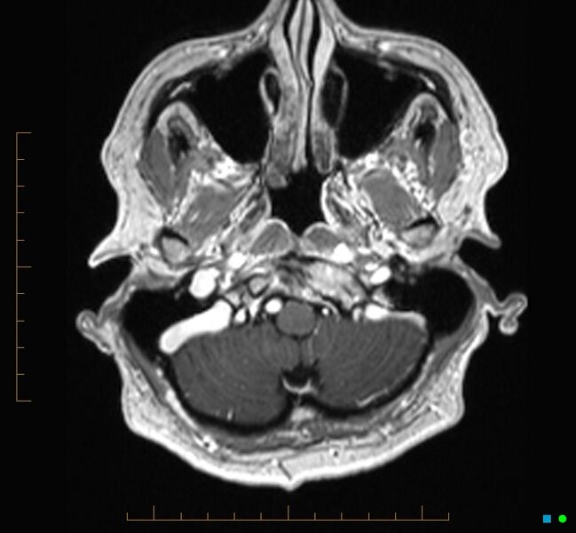 File:Cerebellar gangliocytoma (Radiopaedia 65377-74422 Axial T1 C+ 5).jpg