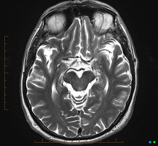 File:Cerebellar gangliocytoma (Radiopaedia 65377-74422 Axial T2 16).jpg