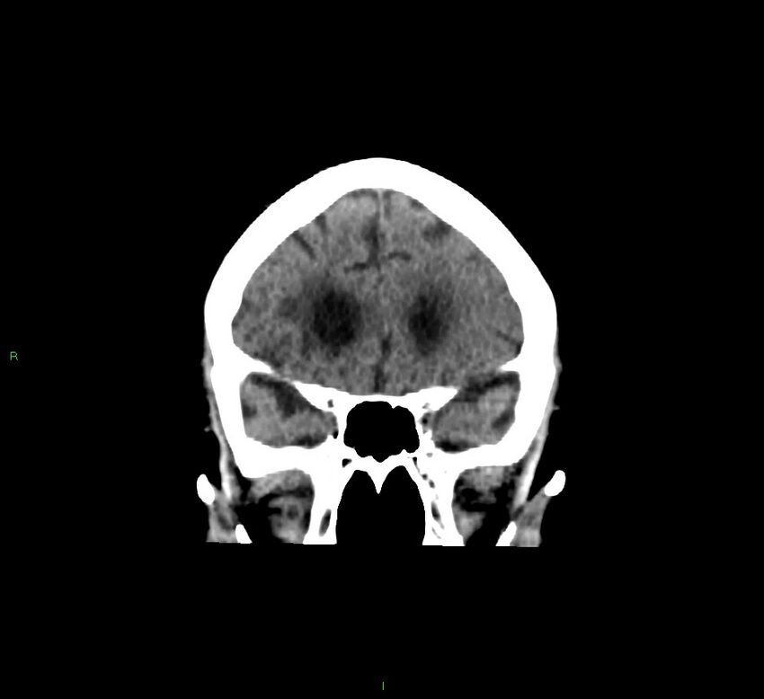 Cerebellar hemorrhage (Radiopaedia 58793-66027 Coronal non-contrast 48).jpg