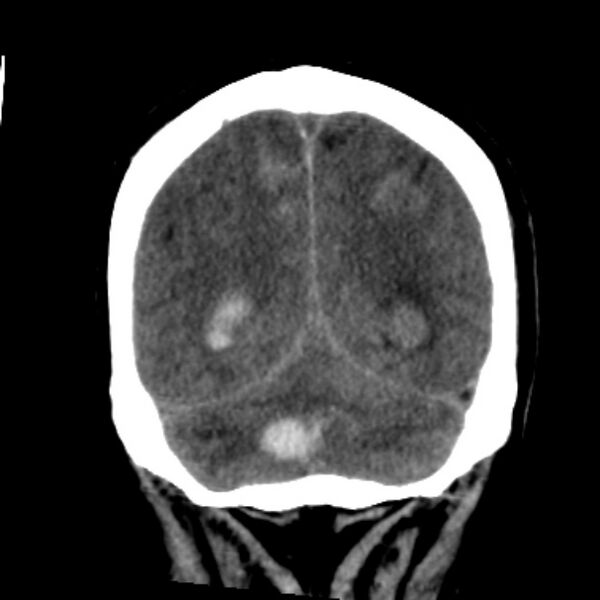 File:Cerebellar hemorrhage causing obstructive hydrocephalus (Radiopaedia 33989-35207 Coronal non-contrast 42).jpg