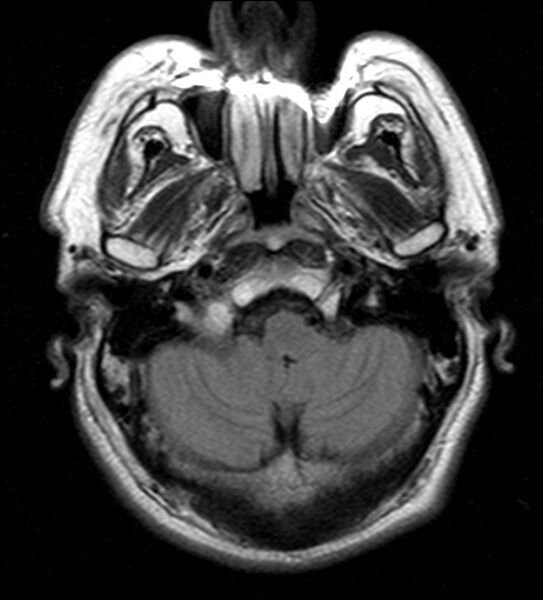 File:Cerebellopontine angle meningioma (Radiopaedia 24459-24764 Axial FLAIR 4).jpg