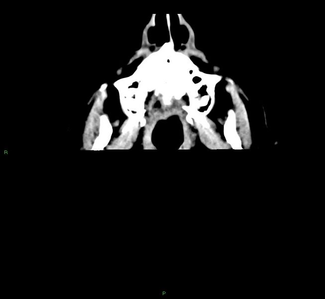 File:Cerebral amyloid angiopathy-associated lobar intracerebral hemorrhage (Radiopaedia 58376-65511 Axial non-contrast 57).jpg