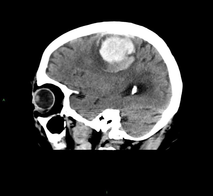 Cerebral amyloid angiopathy-associated lobar intracerebral hemorrhage (Radiopaedia 58376-65511 C 38).jpg