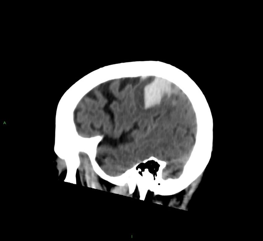 Cerebral amyloid angiopathy-associated lobar intracerebral hemorrhage (Radiopaedia 58376-65513 C 22).jpg