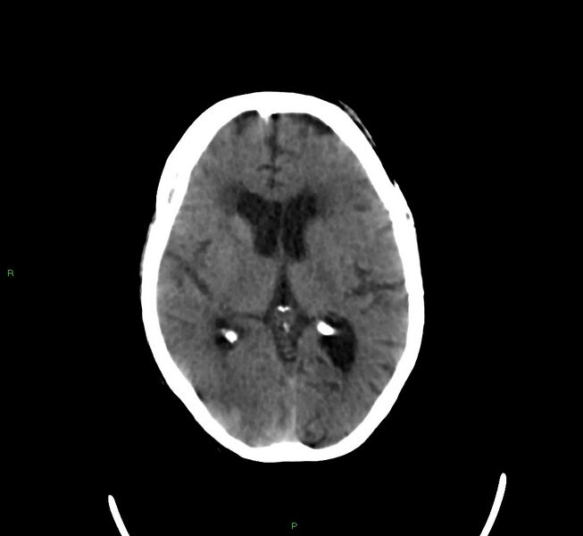 File:Cerebral amyloid angiopathy-associated lobar intracerebral hemorrhage (Radiopaedia 58377-65514 Axial non-contrast 25).jpg
