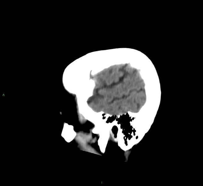 File:Cerebral amyloid angiopathy-associated lobar intracerebral hemorrhage (Radiopaedia 58530-65688 C 8).jpg