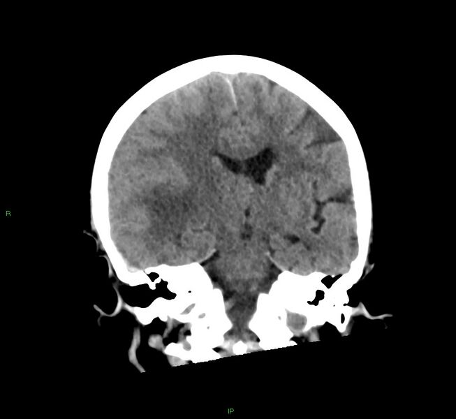 File:Cerebral amyloid angiopathy-associated lobar intracerebral hemorrhage (Radiopaedia 58563-65727 Coronal non-contrast 35).jpg